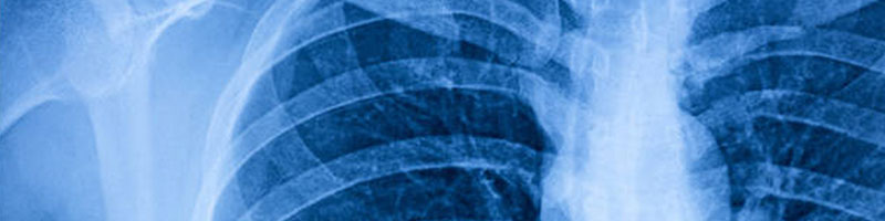 X-ray of chest.