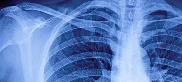 X-ray of chest.