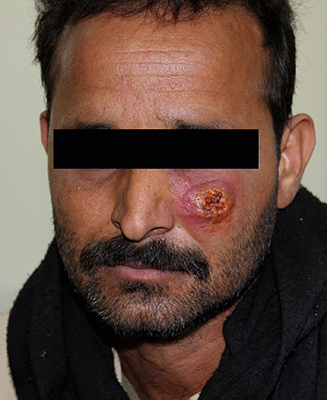 MT Feb 17 leishmaniasis lesion